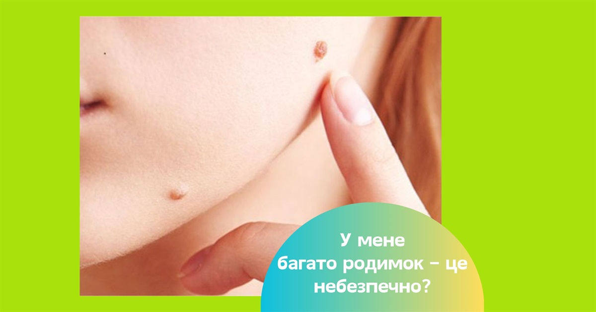 У мене багато родимок – це небезпечно? Що робити і як не захворіти на меланому
