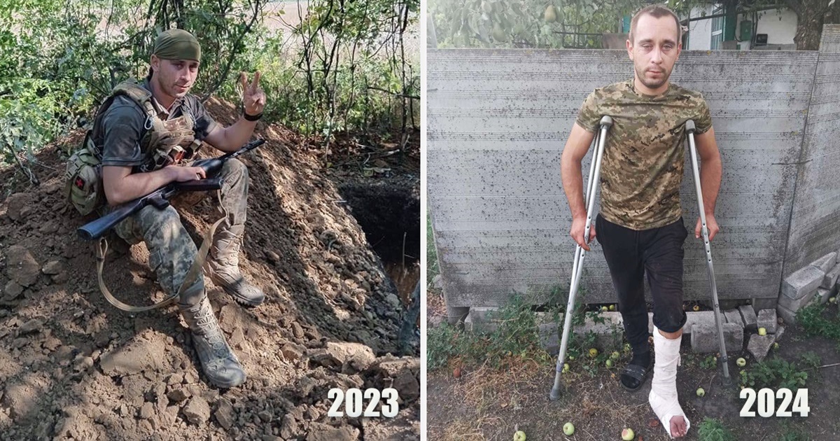 Увага! Збір для захисника з Білопільщини: життя врятоване і є шанс врятувати поранену ногу