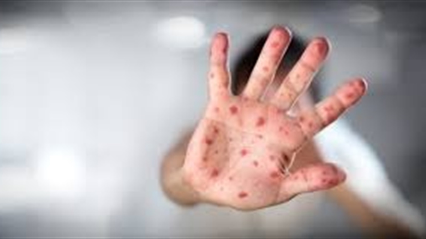 У Волновасі зареєстрували нові випадки захворювання на кір