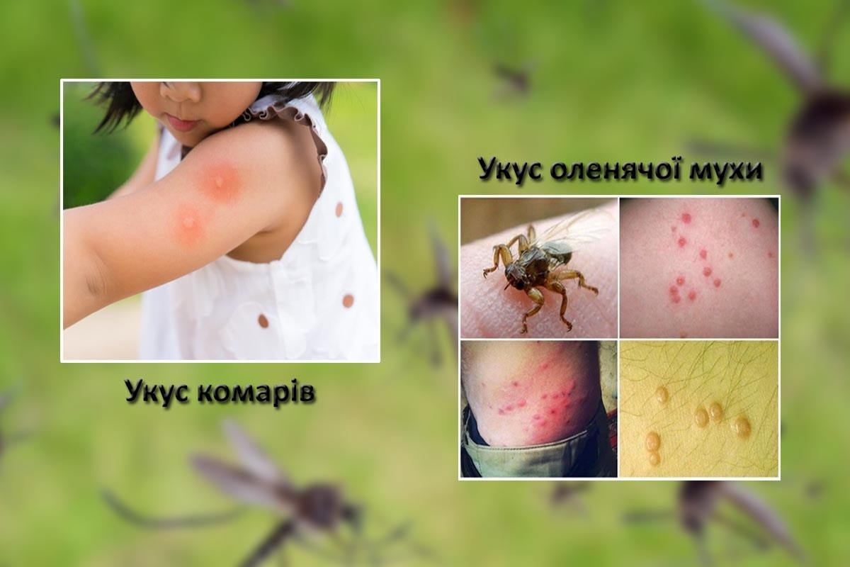 ТОП-10 укусов насекомых, которые надо уметь распознавать - пчелы, слепни, мошки и не только