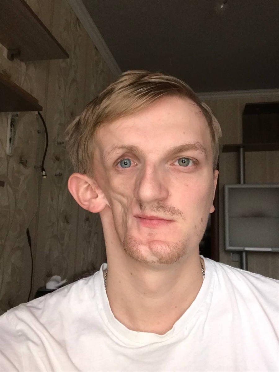 последствия склеродермии