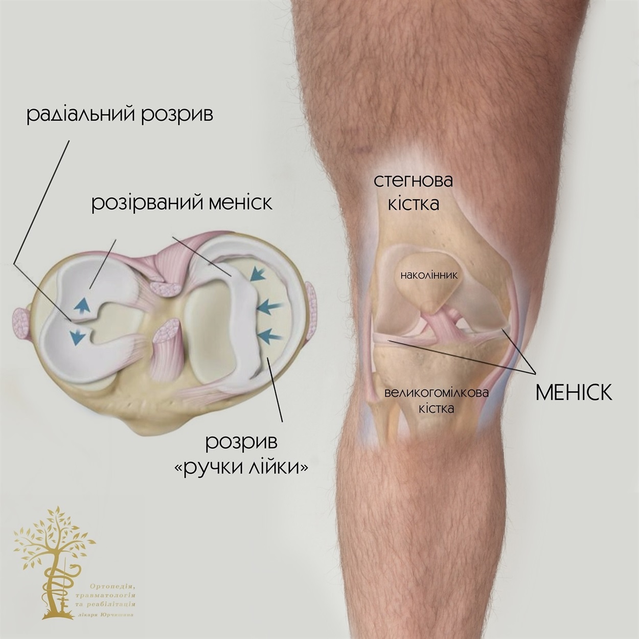 Проблема травм меніску 
