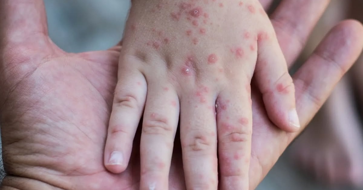 «Непомітний, але небезпечний»: що потрібно знати про вірус коксакі