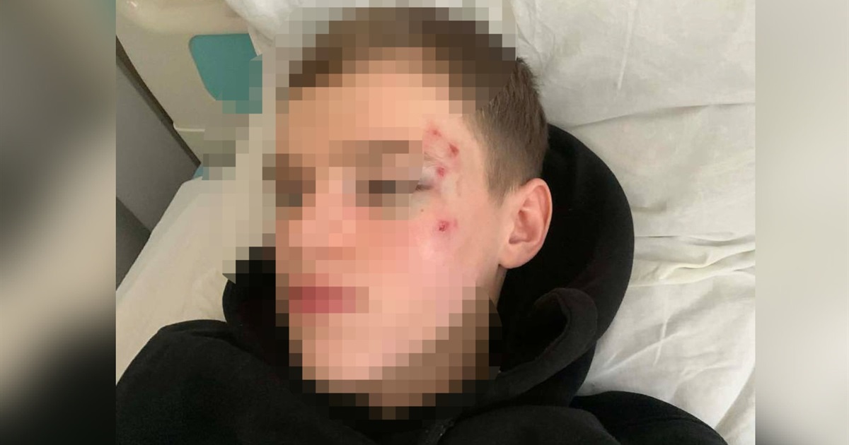 Напад з переломом лицевої кістки в Переяславі поліція кваліфікувала як нанесення легких ушкоджень