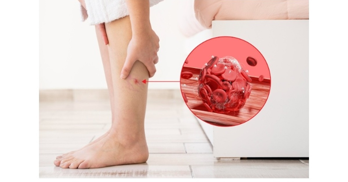 Захворювання вен: причини, прояви та профілактика