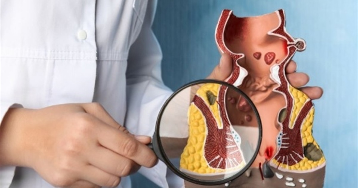 Коли можна повернутися до сидячої роботи після лікування геморою?