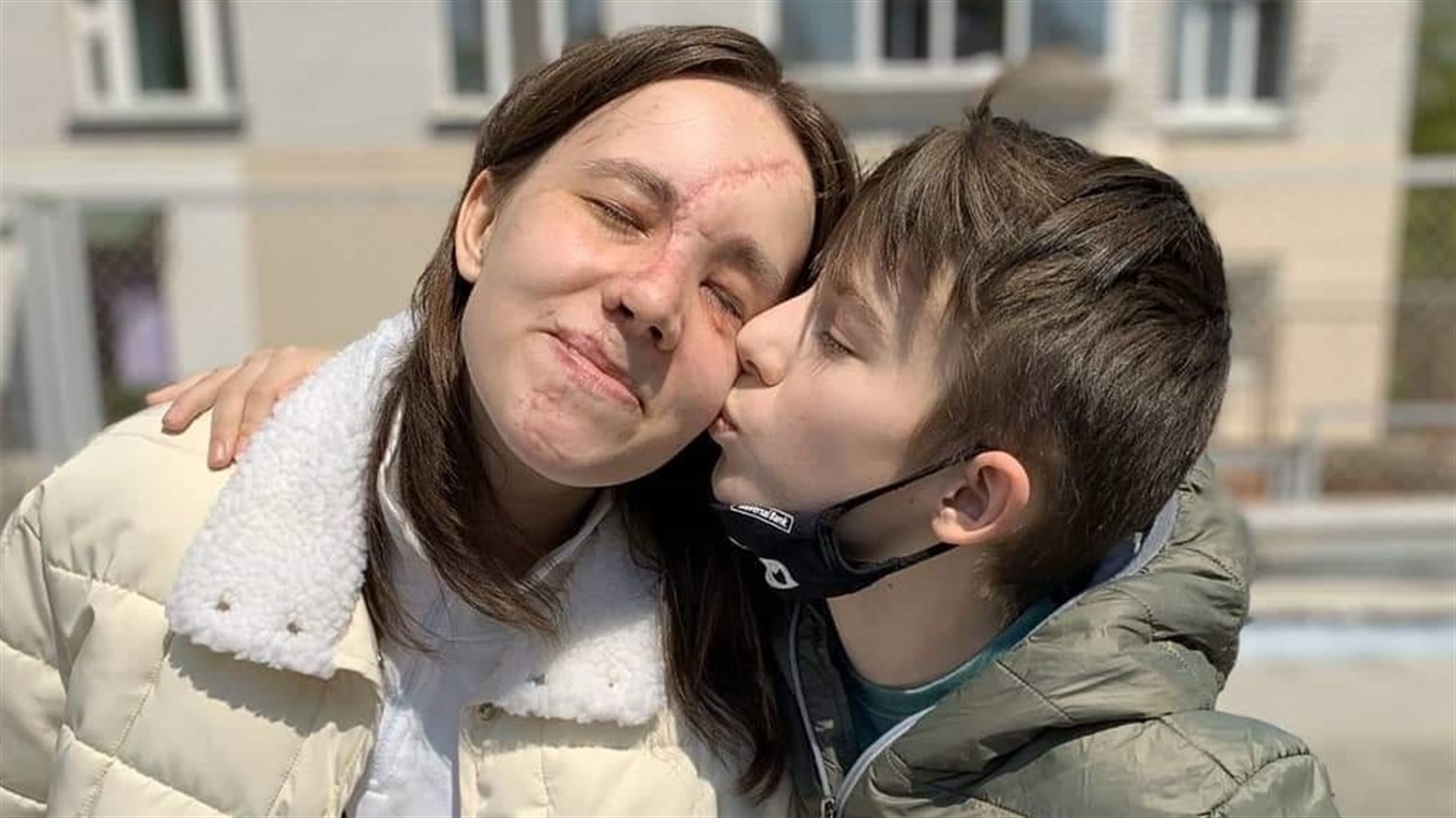 Брат и сестра выжили в страшном ДТП, перенесли несколько операций и, наконец, встретились