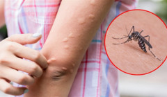 Кусається не тільки природа: як уберегтися від комах у теплий сезон