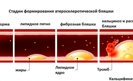 Что такое атеросклероз