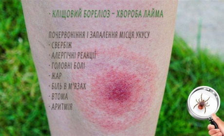 Серед нетішинців зафіксовано випадки хвороби Лайма – від укусів кліща