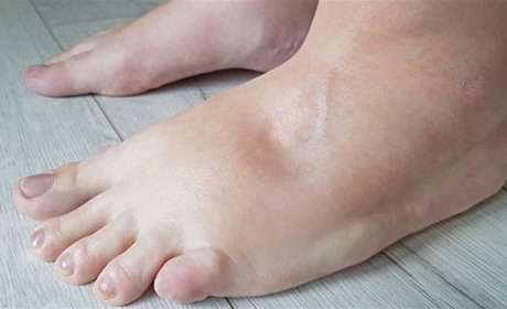 Затримка рідини в організмі: чому це небезпечно і як її позбутися