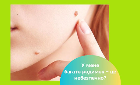 У мене багато родимок – це небезпечно? Що робити і як не захворіти на меланому