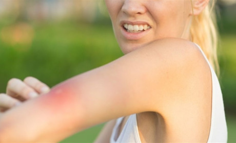 Весна, тепло і... мошки: як жителям Білопільщини від них захиститись і що робити у разі укусів