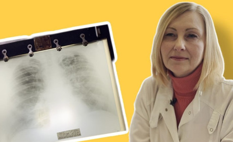 Лікар зі Жовтих Вод відповідає на запитання про туберкульоз: чим небезпечна ця хвороба