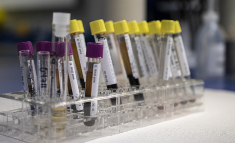 На Луганщині плюс один хворий на COVID-19. Досліджують ще 106 зразків