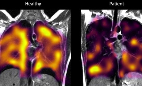 Постковідний синдром може тривати від 5 тижнів і довше: слабкість, кашель, задишка, головний біль