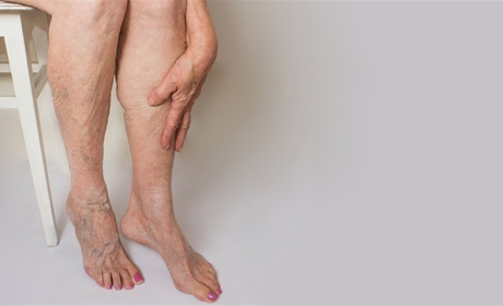 Варикозная болезнь: что нужно знать?