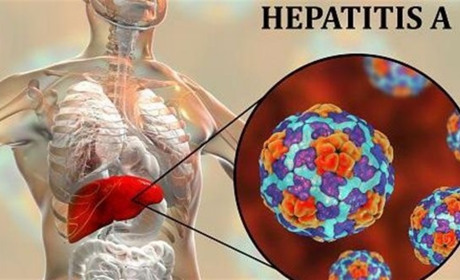 У Шостці виявили хворого, зараженого гепатитом А