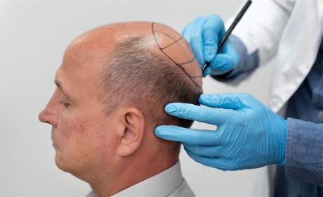 Пересадка волосся — інвестиція у себе: скільки це коштує і що входить у вартість