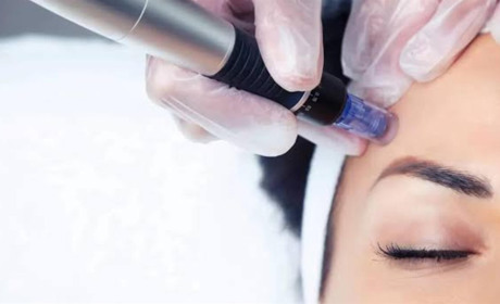 Дермапен: що це за процедура та чому вона стала обов’язковою у кабінеті косметолога