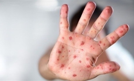 В Одесі двоє дітей захворіли на кір: не були вакциновані. Проводять заходи, щоб попередити спалах