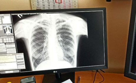 Місяць боротьби із туберкульозом: як минув і яка ситуація із цим захворюванням у Гадячі