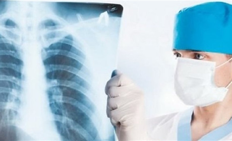 Лише за листопад на Хмельниччині діагностували 33 випадки туберкульозу