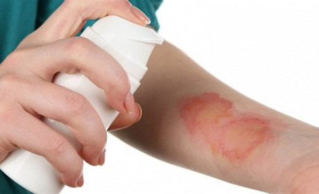 Перша допомога при термічних опіках і обмороженнях: що робити та коли звертатися до медиків