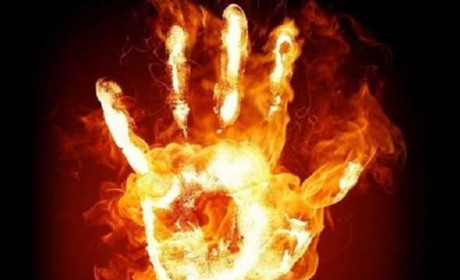 У Вараському районі під час пожежі чоловік отримав опіки