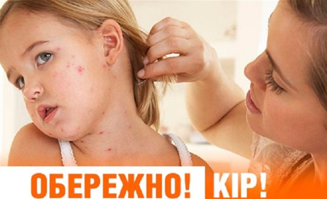 За півтора місяці 2019 року зафіксували більше випадків кору, ніж за весь 2018-й