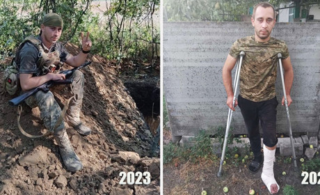 Увага! Збір для захисника з Білопільщини: життя врятоване і є шанс врятувати поранену ногу