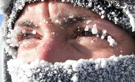 Як жителям Білопільщини розпізнати обмороження та що робити: МОЗ радить