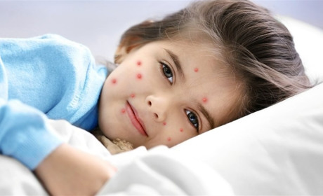 Вітряна віспа набирає обертів: що потрібно знати про хворобу