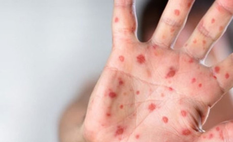 У Старокостянтинові виявили кір