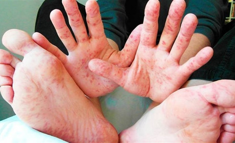 У Старокостянтинові та районі 14 хворих на кір