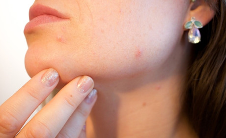 Спалах кору: що потрібно знати старокостянтинівцям, аби вберегтися від хвороби