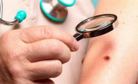 Меланома STOP: як зберегти шкіру здоровою