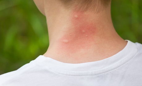 Що робити, якщо вкусив комар