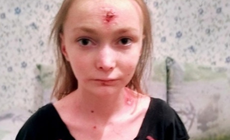 Помоги своим: 16-летняя Аня борется с неизлечимой болезнью и нуждается в помощи