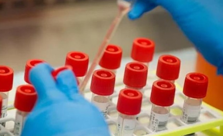 Оновлений алгоритм тестів на COVID-19: робитимуть усім з ознаками коронавірусу, ГРВІ та пневмонії 