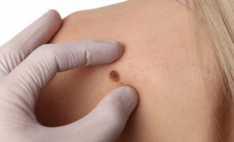 Що треба знати про меланому — один з найнебезпечніших видів раку. Ознаки і діагностика