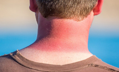 Отримав сонячні опіки: що потрібно робити?