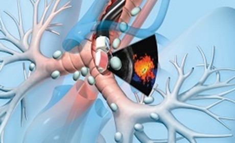 Де у Чернівцях можна безоплатно пройти бронхоскопію і навіщо це робити?