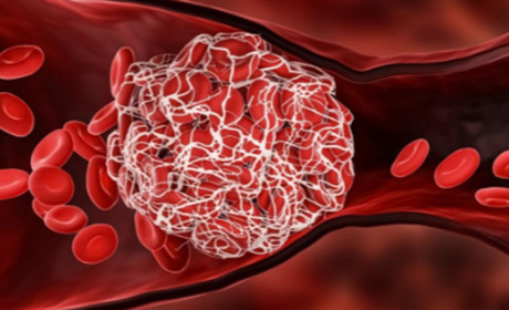 Тромбоз як ускладнення COVID-19. Ознаки, симптоми та фактори ризику
