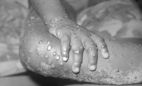 Мавпяча віспа шириться світом: що варто знати і як уберегтися