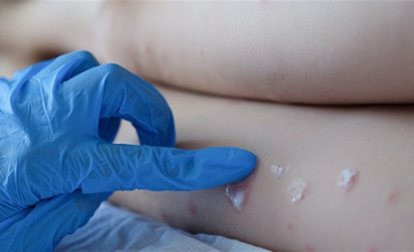 Мавпяча віспа шириться країнами Європи: що це за хвороба та як вберегтися