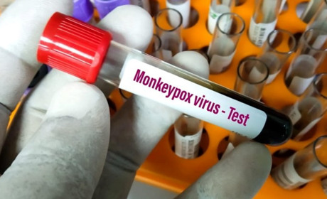 Мавпяча віспа біля кордонів України: Одещина отримала перші тести для виявлення вірусу