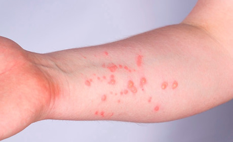 15 вересня в Україні лабораторно підтвердили перший випадок віспи мавп