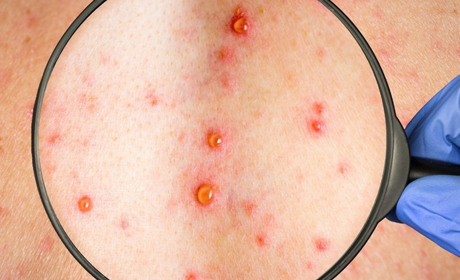 Віспа мавп в Україні: зафіксовано перший випадок