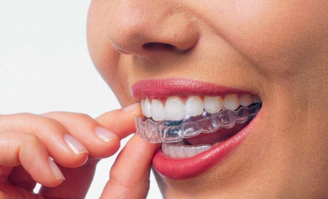 Ортодонтія з ювелірним ефектом: що потрібно знати про сапфірові брекети